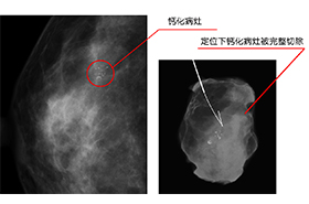钼靶定位下乳腺钙化切除术